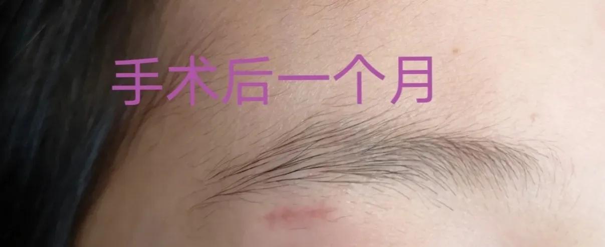 皮脂腺囊肿和粉刺瘤,火针治疗皮脂腺囊肿