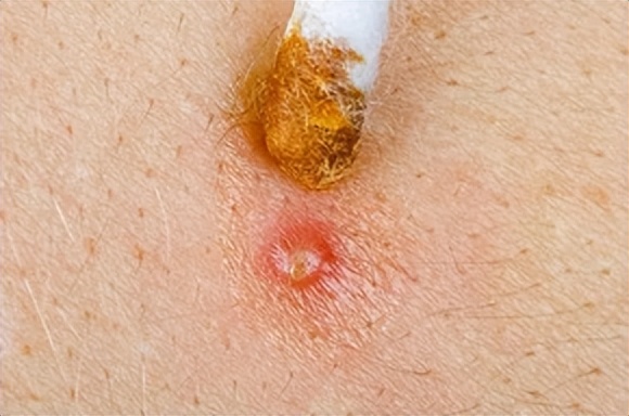 生活中最常见的4种皮肤病,皮肤科可以看多种皮肤病吗