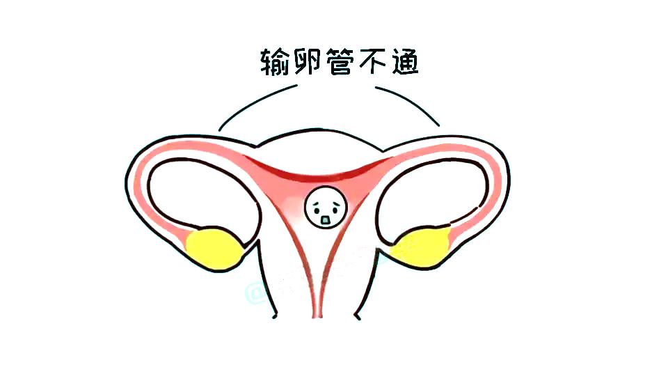 老中医偏方输卵管堵塞,输卵管不通开活血化瘀的中药