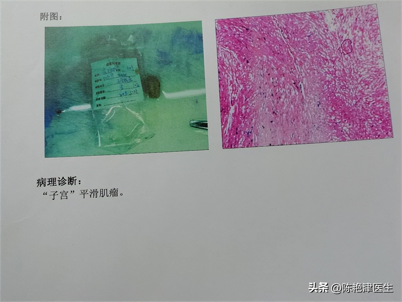 女性为什么容易长子宫肌瘤？提醒：平时尽量避免3个行为，别忽视