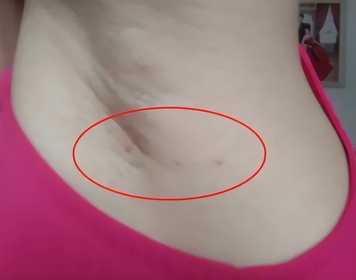 脖子上的小肉粒揪掉后会怎样,脖子上透明小肉粒可以揪下来