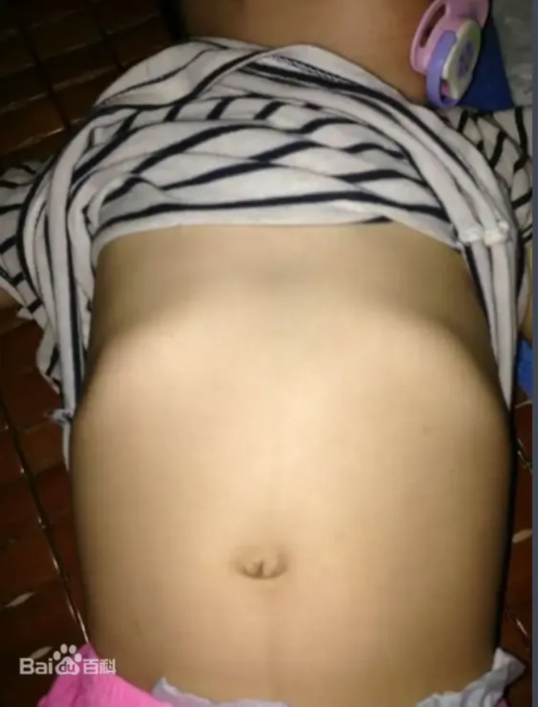 孩子肋骨外翻正常吗需要补钙吗,肋骨外翻补钙后会变正常吗