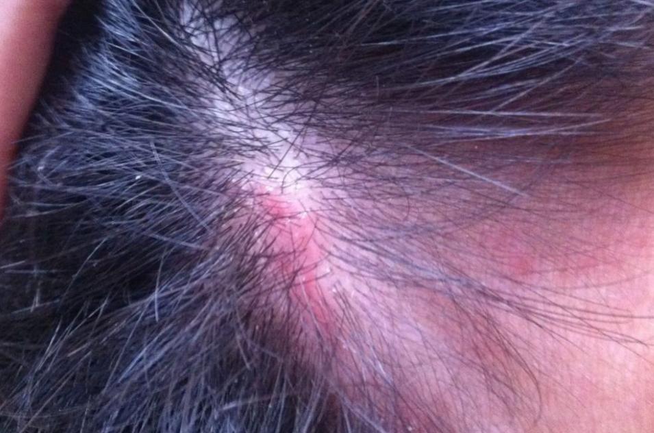 用艾叶熬水洗头3个月有什么变化,艾叶煮水洗头六个月后身体变化