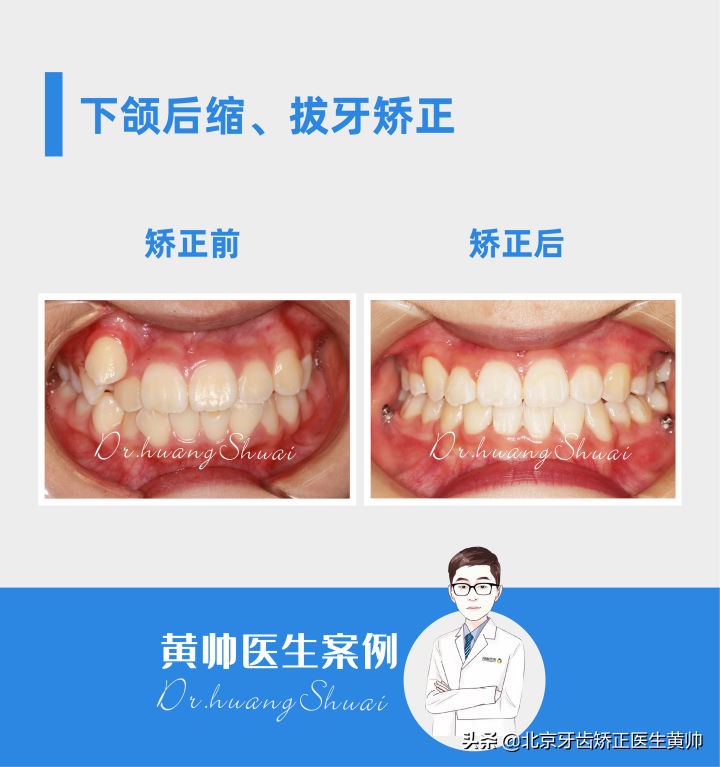 嘴凸的人怎么笑起来好看,嘴凸怎么让自己不焦虑
