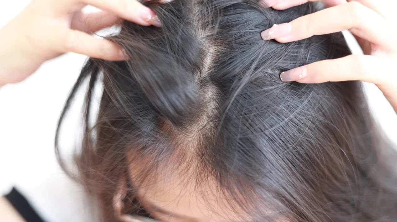 头皮屑多跟饮食有关吗,头皮屑多应该要吃什么