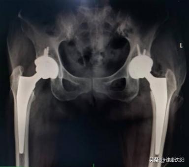 老年人怎么会引起股骨颈骨折,高龄老人股骨颈骨折怎么办恢复快