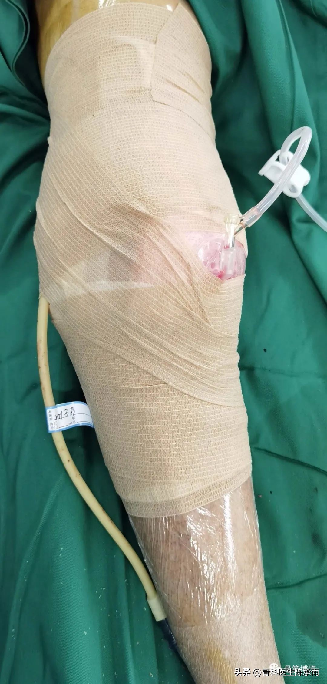 化脓性关节炎的穿刺引流治疗,关节炎镜下治疗