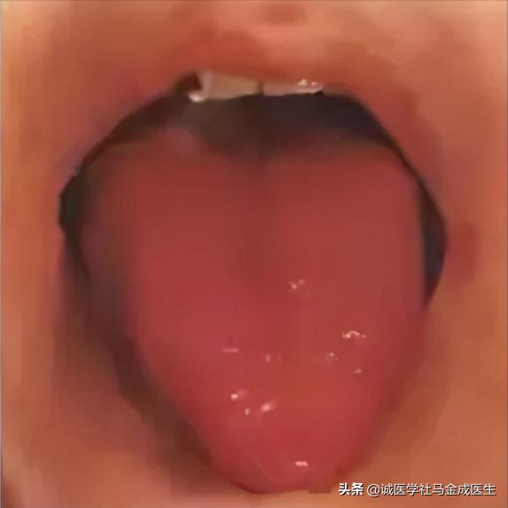 咳嗽痰多干咳阴虚内热,内热咳嗽痰多吃什么好得快