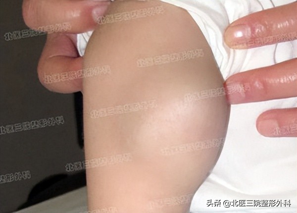 中医治疗舌淋巴管畸形,淋巴管畸形是什么原因导致的