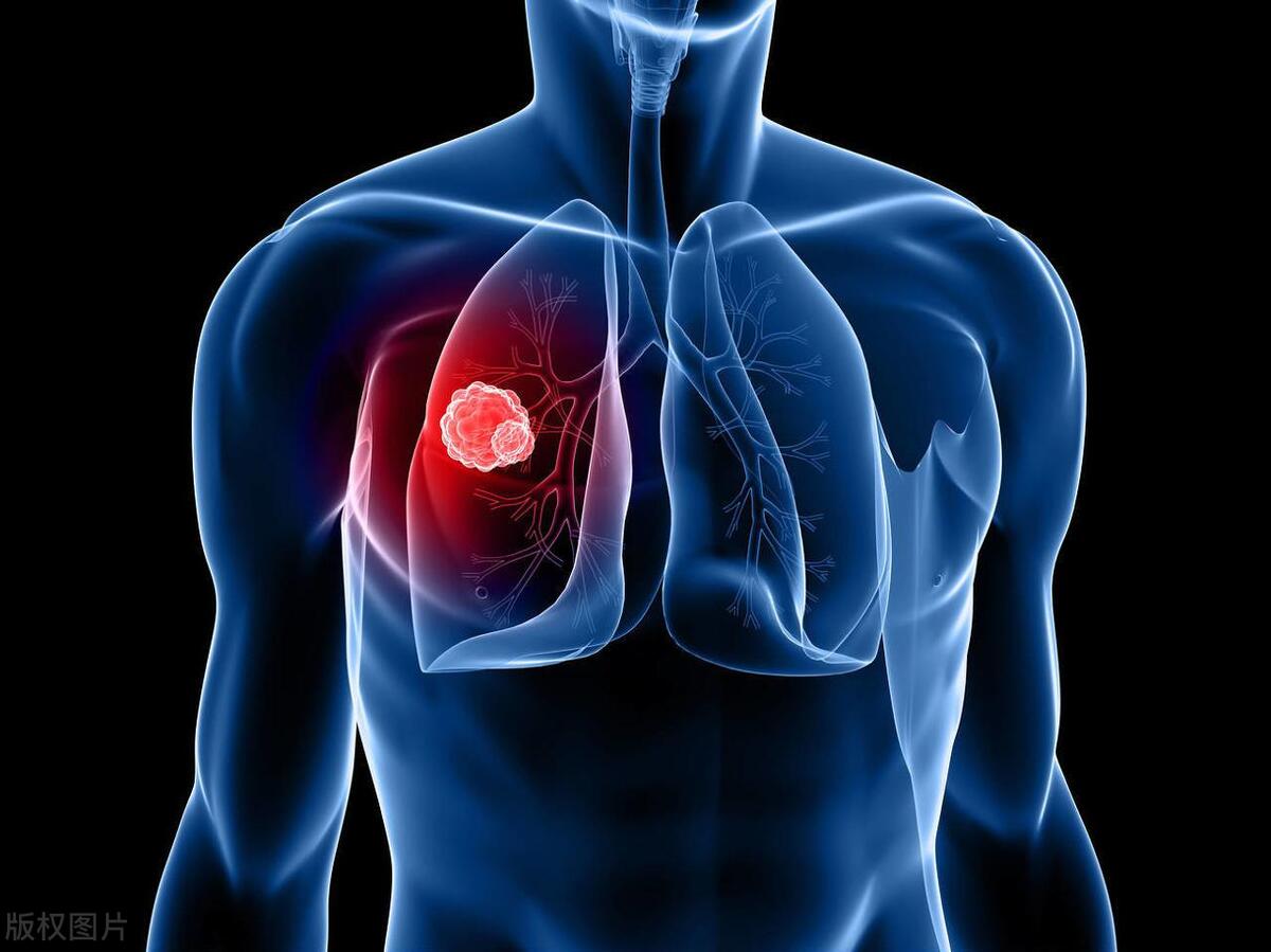 原位癌不变化要不要手术,原位癌不属于重疾吗