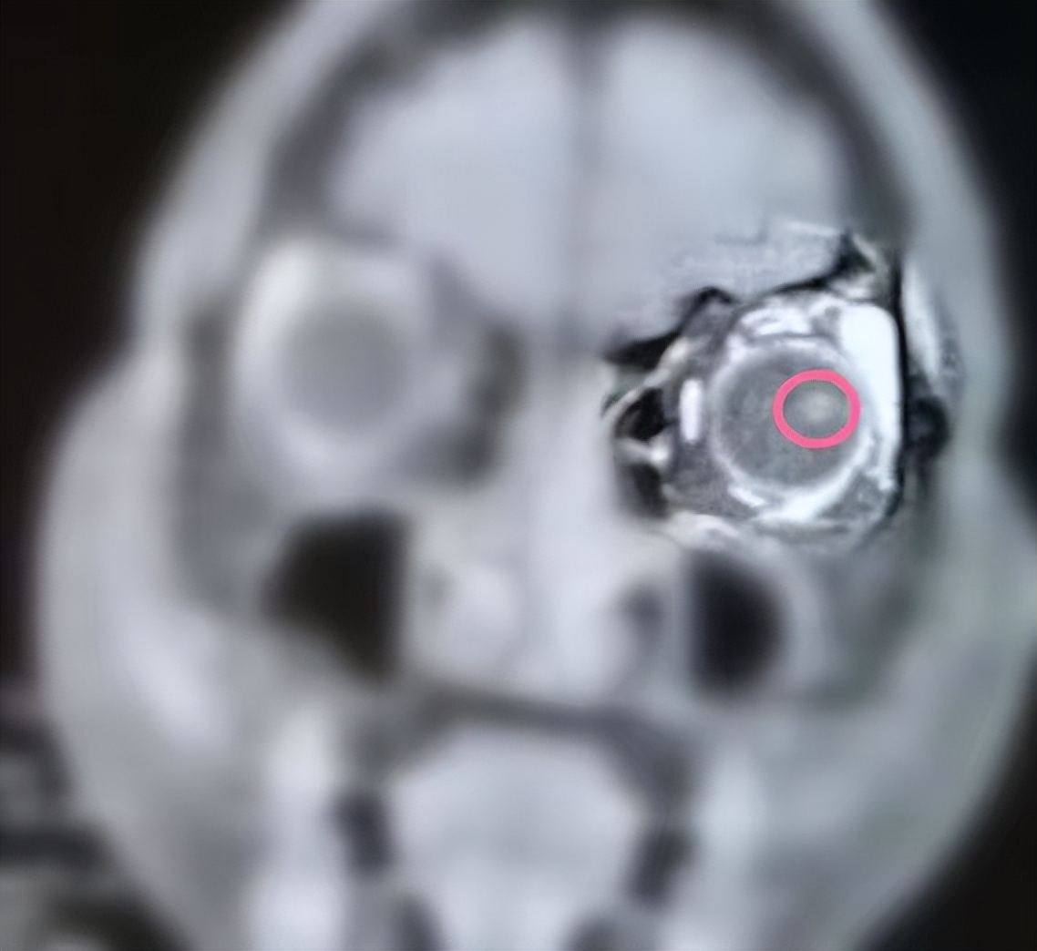 视物模糊黑影晃动,视物有黑影浮动且视力不断下降