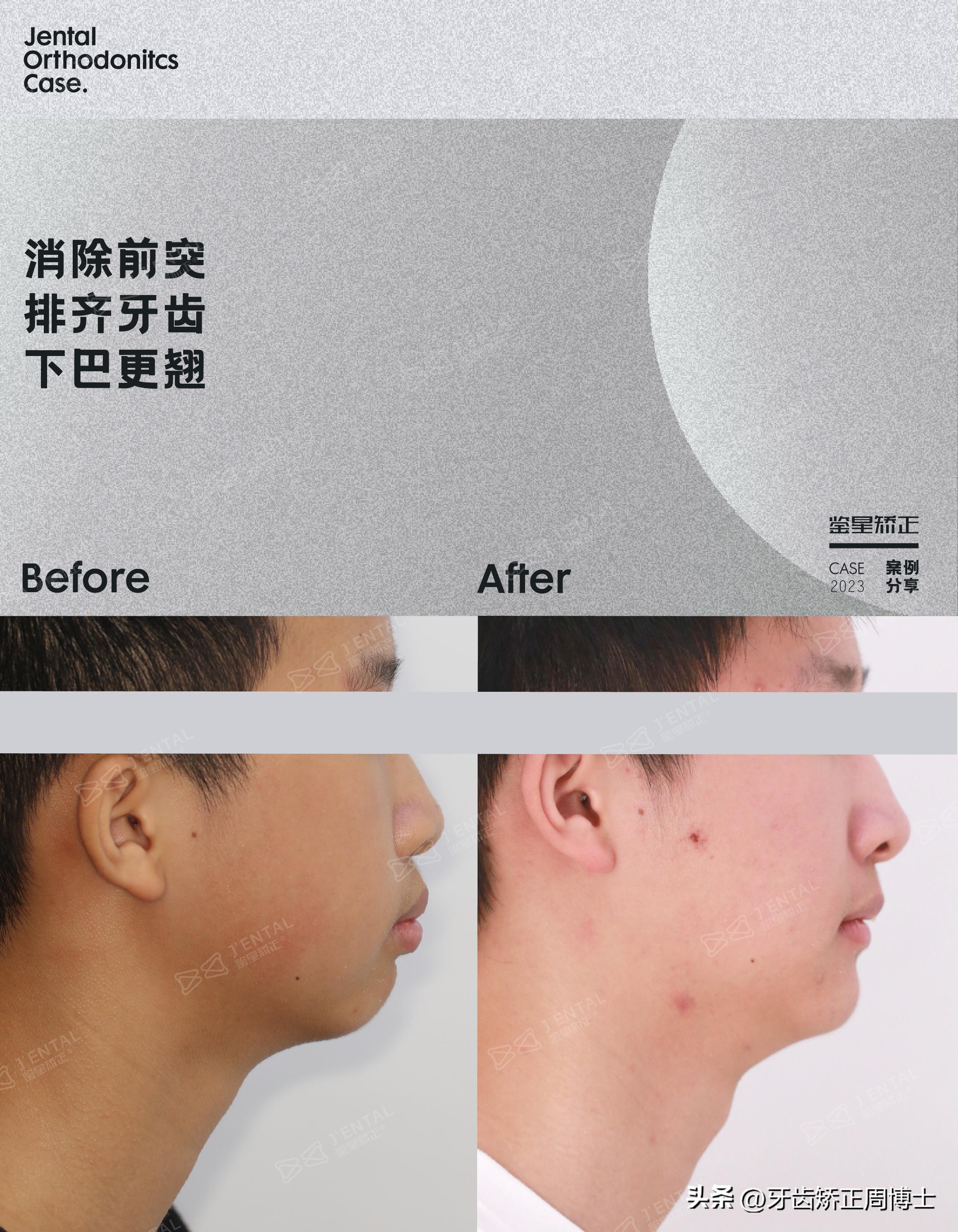 拔掉大牙做矫正好还是植牙好,拔掉4颗牙齿正畸收缝有几种方法