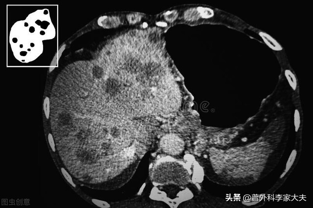 肝癌晚期转移到肺能生存多久,肝癌晚期治疗首选和最有效的方法