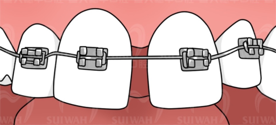 中山大学附属口腔医院牙缝修复,苏州华夏口腔修复牙缝