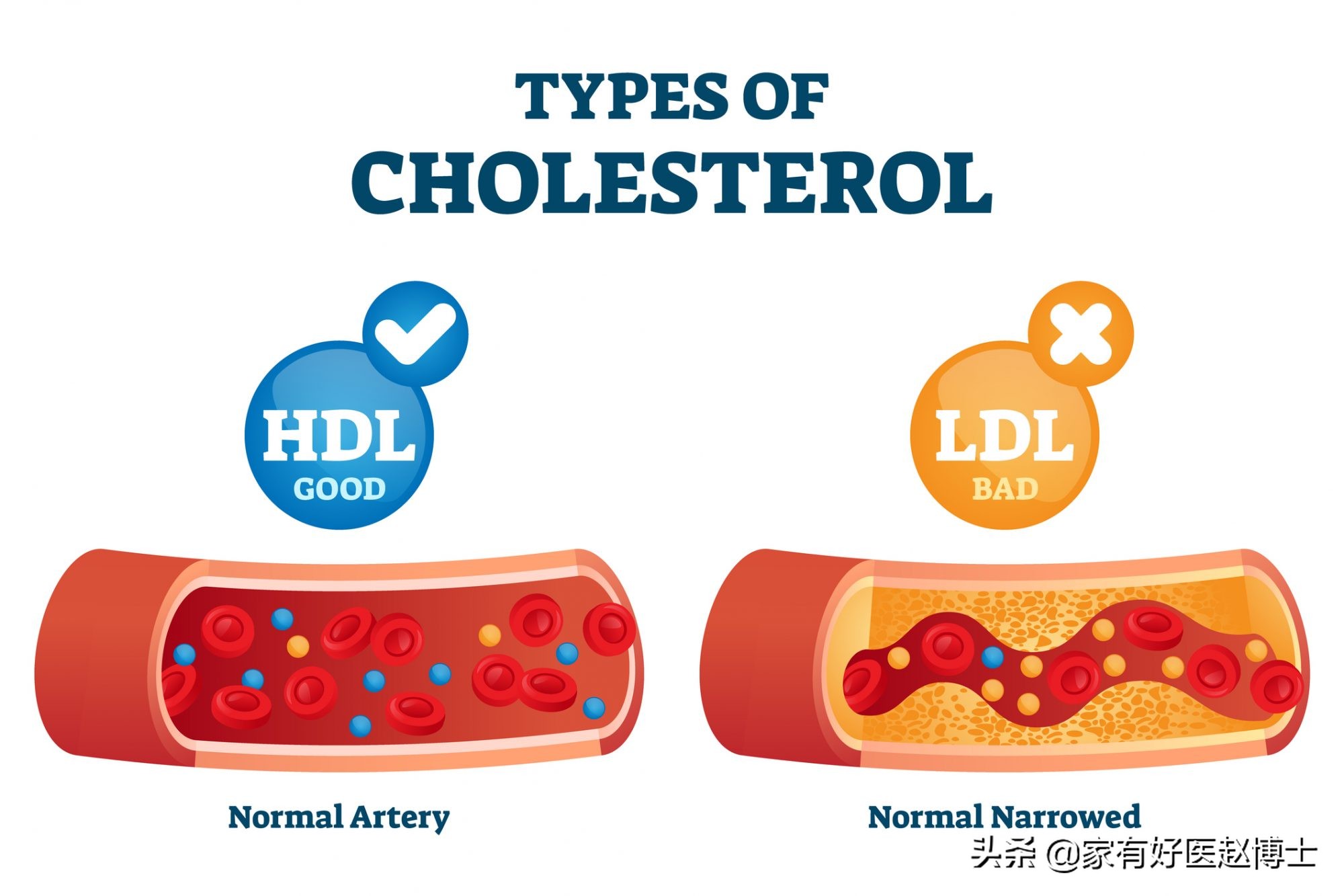 影响胆固醇的高低哪六项重要因素,胆固醇偏高的危害和预防