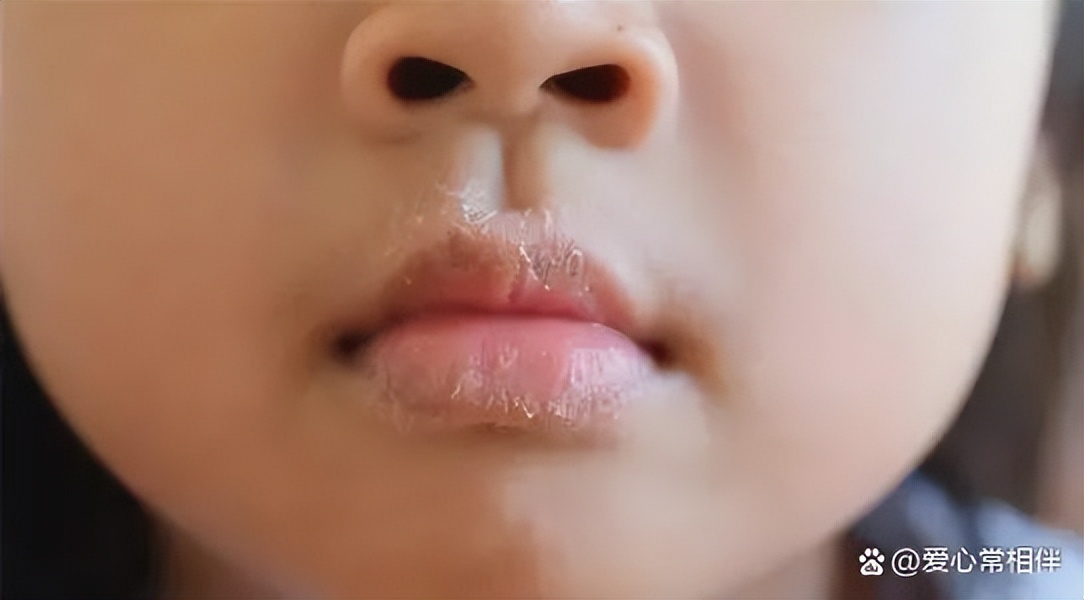 孩子嘴唇干老舔都红了怎么办,孩子嘴唇干起皮用什么药