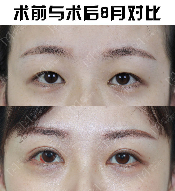 割双眼皮是属于整形还是美容,割双眼皮就是整容吗