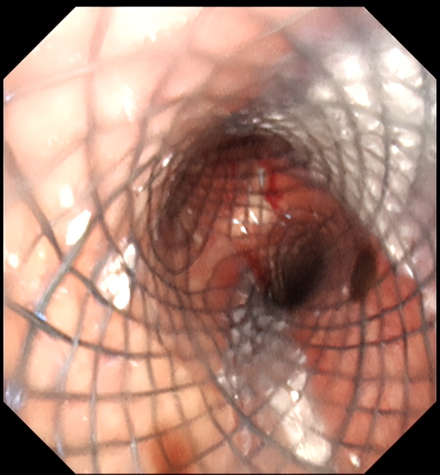 太原市中心医院呼吸介入团队成功开展经气管镜肿瘤微波消融治疗术