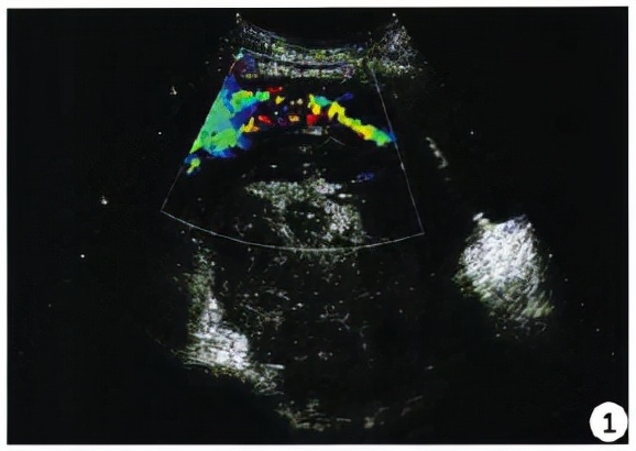 女子宫外孕后得知男子已婚,16岁少女被查出宫外孕