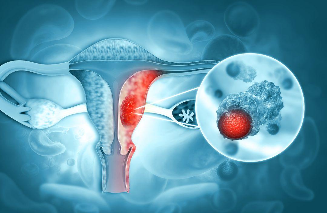 宫颈病变了是不是卵巢也病变了,宫颈病变小腹胀痛是什么程度