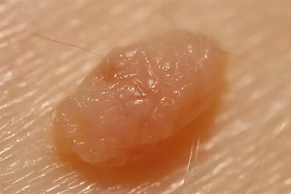 脖子和腋下的小肉粒可以揪了吗,脖子上的小肉粒揪掉后会怎样