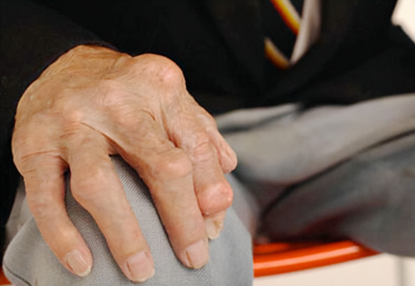 风湿性关节炎的最佳食疗方法,国医大师治疗风湿性关节炎经验方