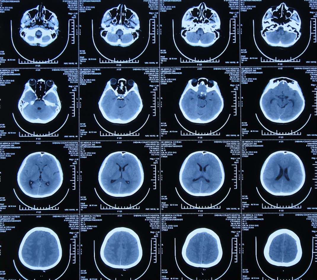 结核脑炎型脑积水怎么治,结核性脑膜炎2期很严重吗