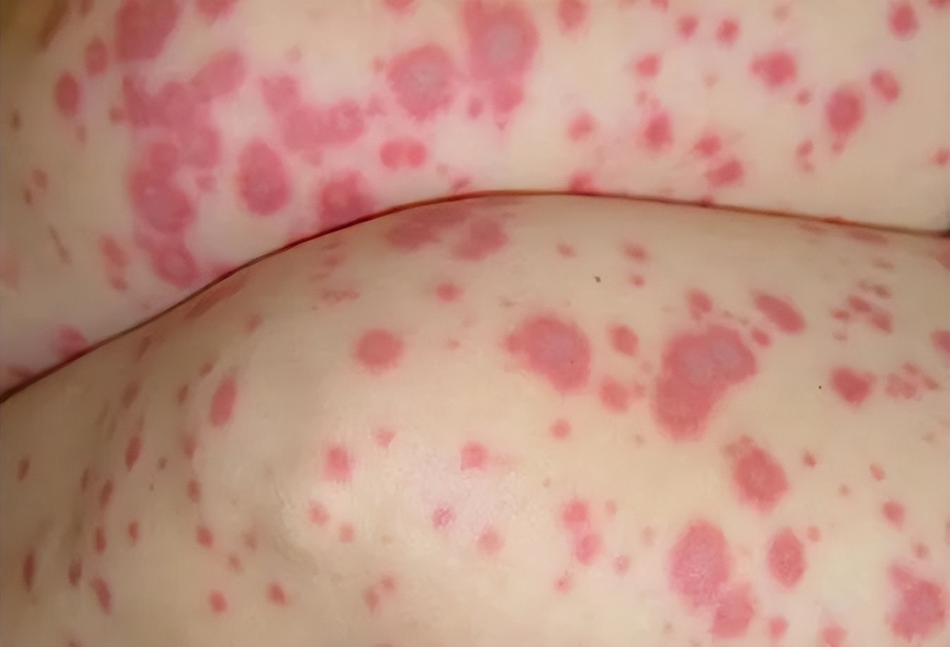 5岁宝宝刚确诊川崎病会康复吗,小孩被误以为是肺炎