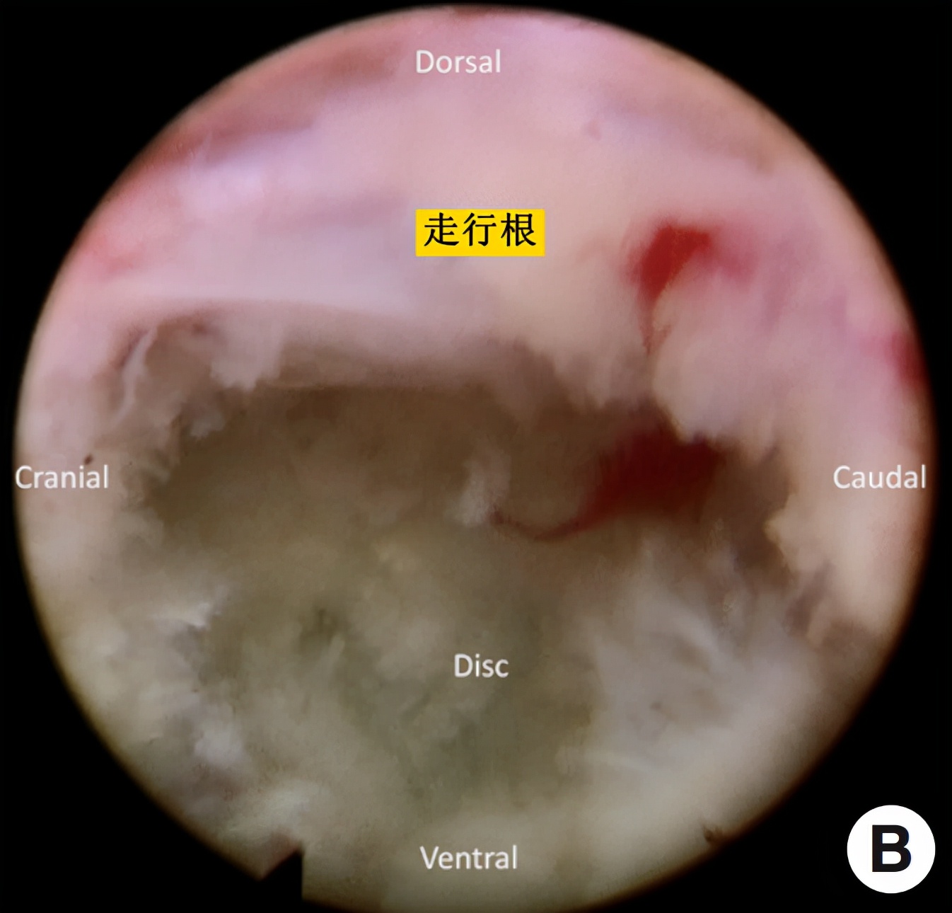 椎间孔镜微创介入治疗椎间盘突出,腰3-4椎间盘突出针刀治疗