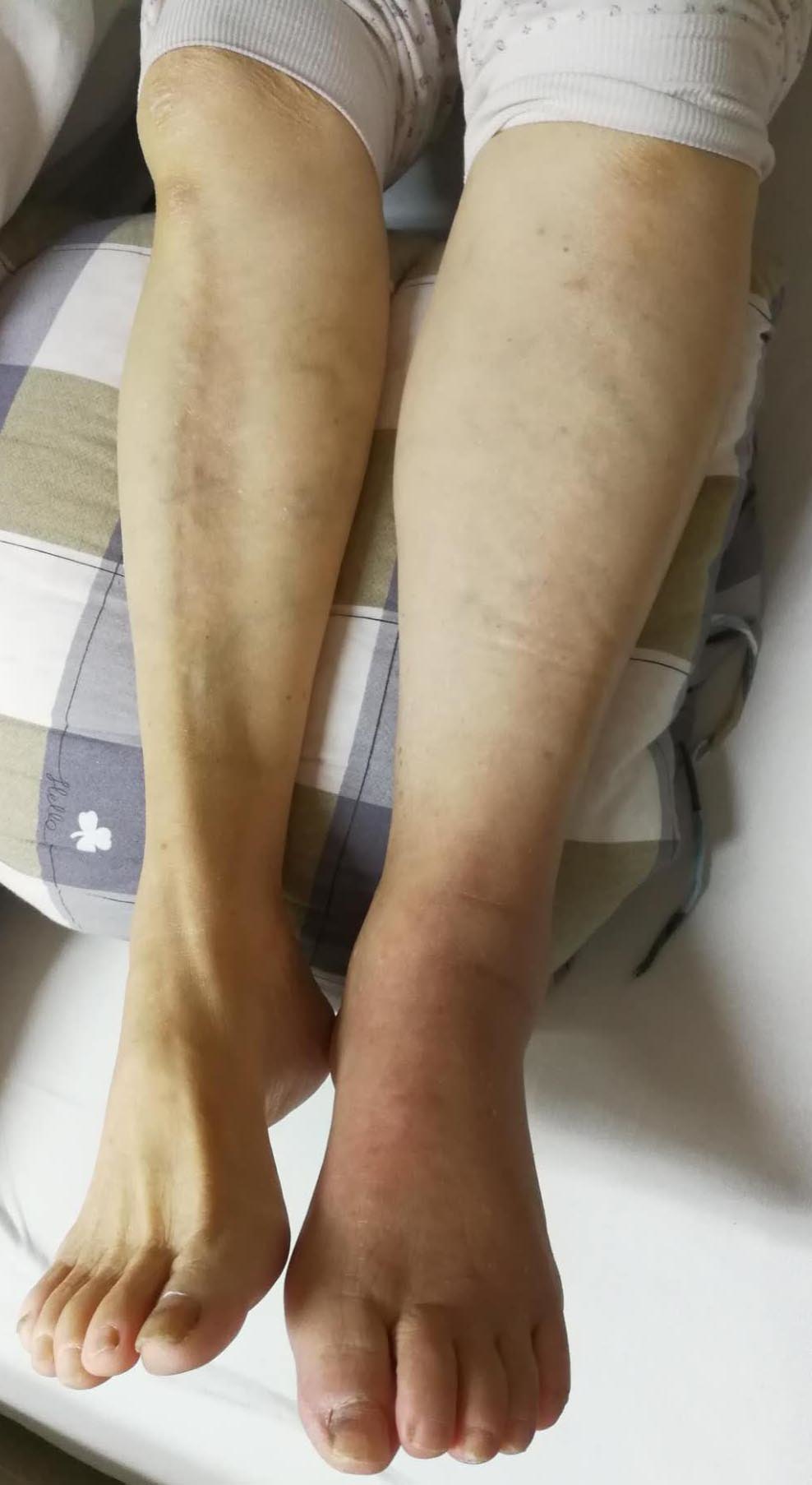 动脉瘤蛛网膜下腔出血术后并发症,动脉瘤导致蛛网膜下腔出血严重吗