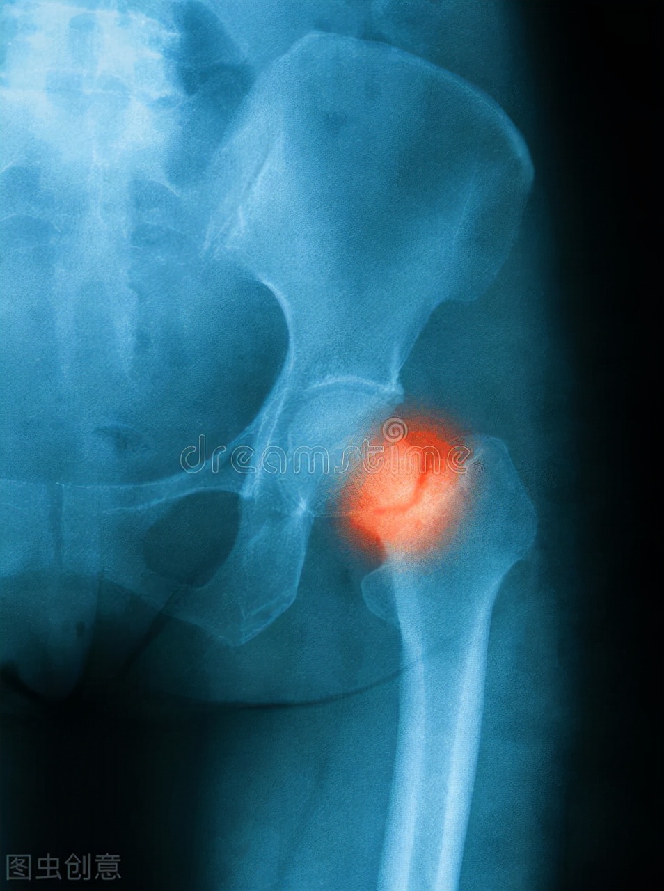 老人跌倒有多严重养成防跌倒意识,老年人跌倒骨折是什么原因