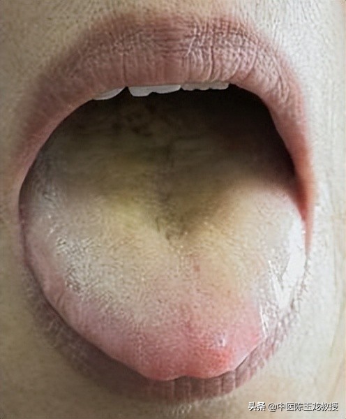 湿热最怕的草药,脾胃湿热和肝胆湿热同治的中成药