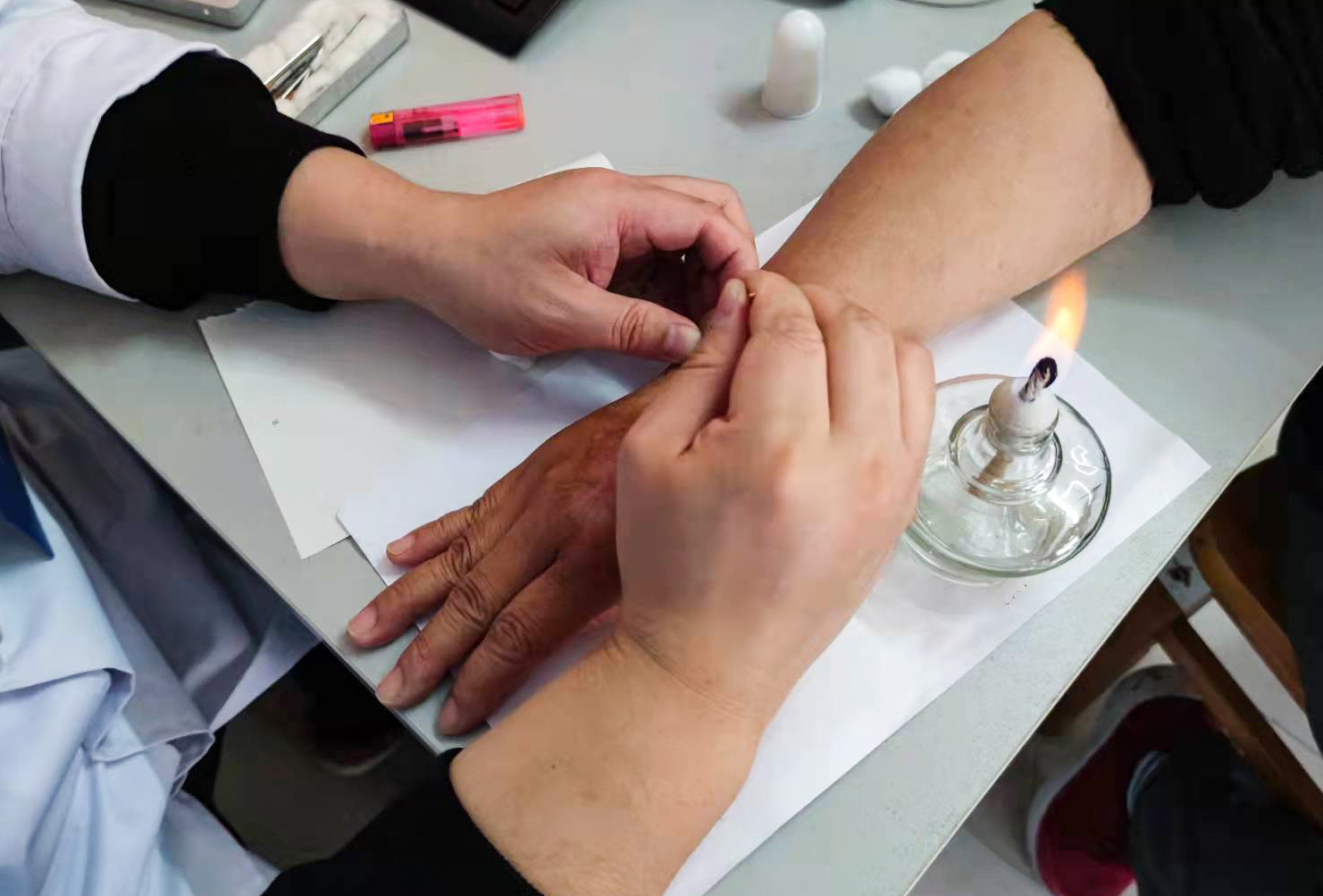 针灸治痒疹,火针治皮肤瘙痒