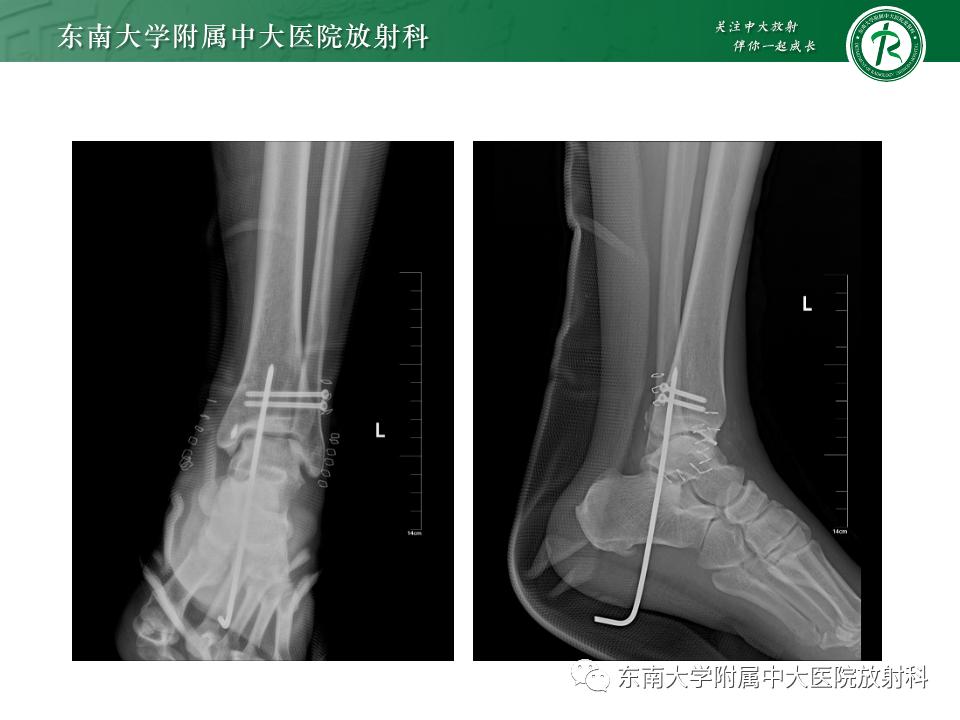 左腓骨下段骨折伴下胫腓联合分离,好文分享深度揭秘