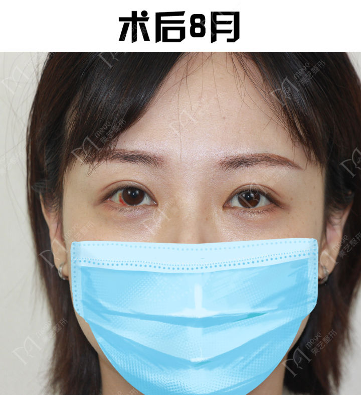 内双贴双眼皮贴可以变外双吗,双眼皮贴内双变外双