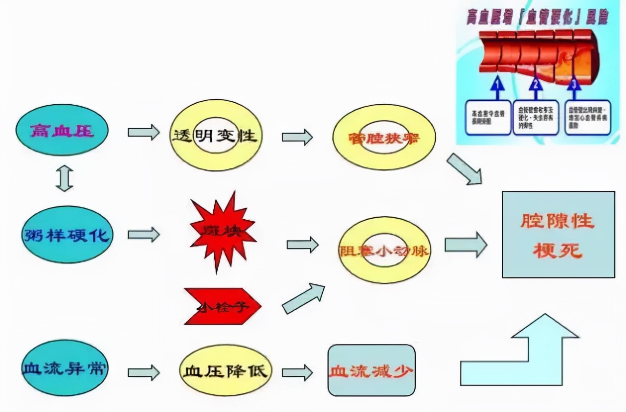 脑部小血管病最有效的治疗方法,小脑梗死疑难病例讨论
