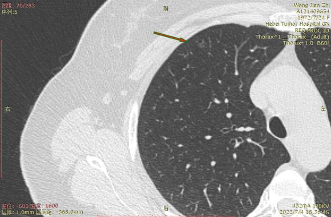 首次发现磨玻璃结节要吃药消炎吗,磨玻璃结节警惕合并占位