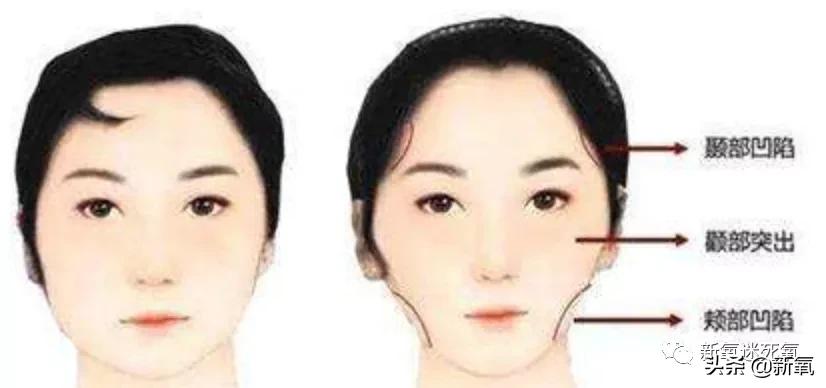 为什么整牙脸会小,为什么整牙期间脸会变老