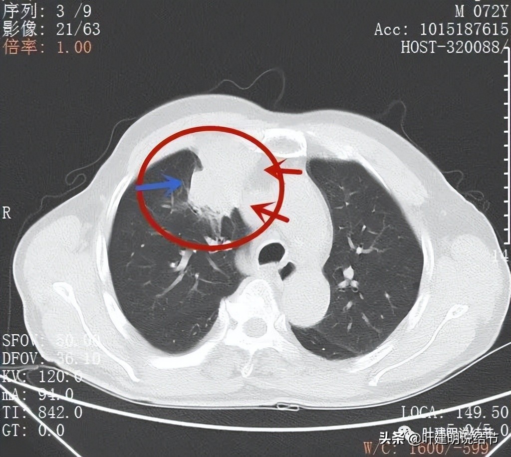 经验：肺占位超6厘米，不是癌还会是什么？临床上仍得多个心眼