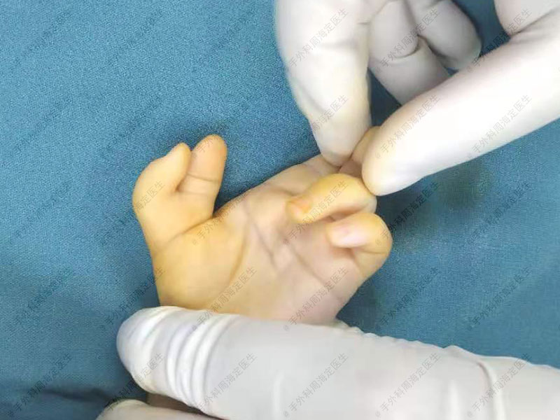 宝宝大拇指有两个可以切除吗,小孩多个手指头什么时候手术合适