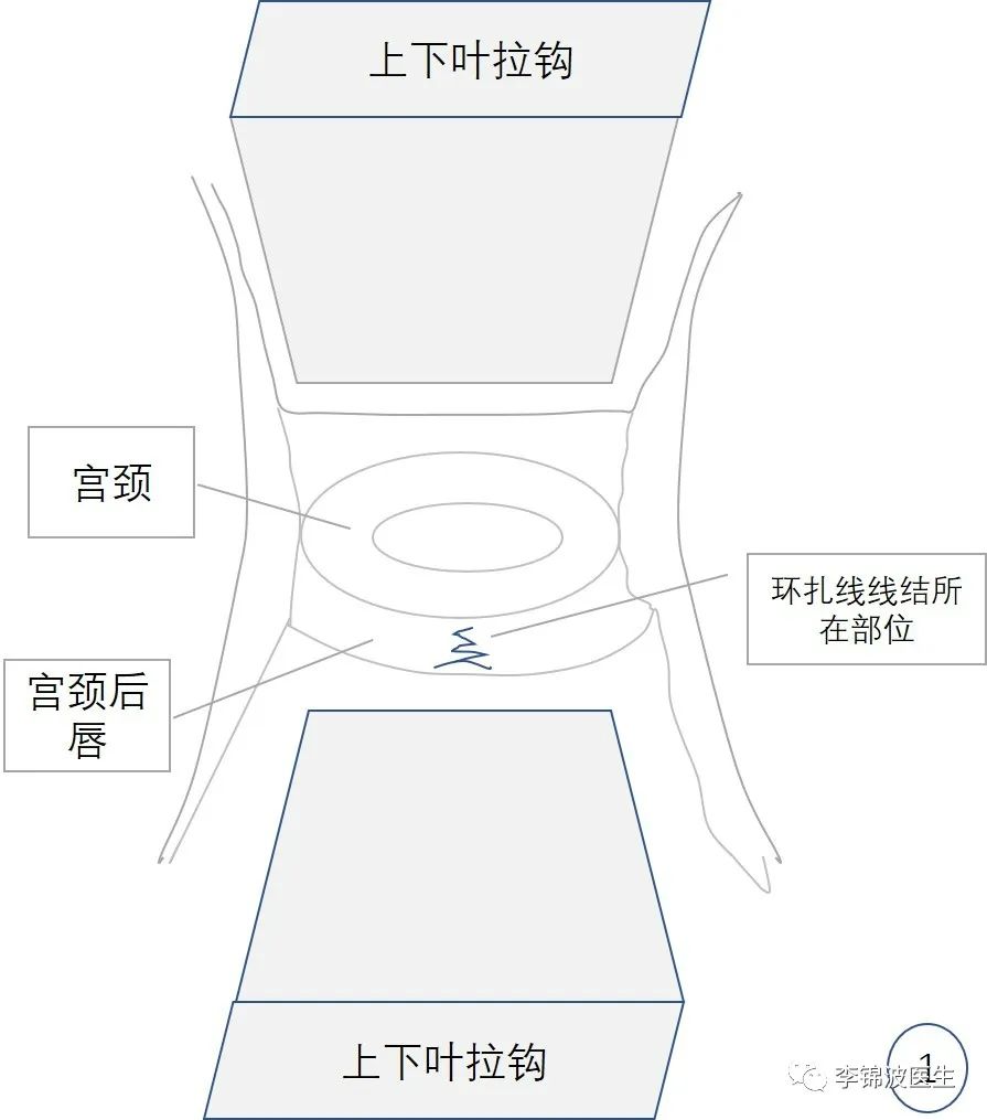 拆除高位宫颈环扎线的步骤和注意事项