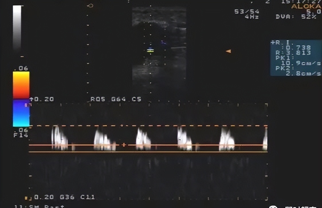 腋窝包块超声鉴别诊断,腋窝淋巴结检查法