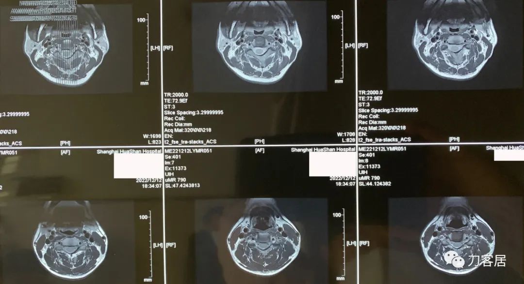 颈椎病七八年了到底要不要动手术,颈椎病不手术保守治疗可以吗