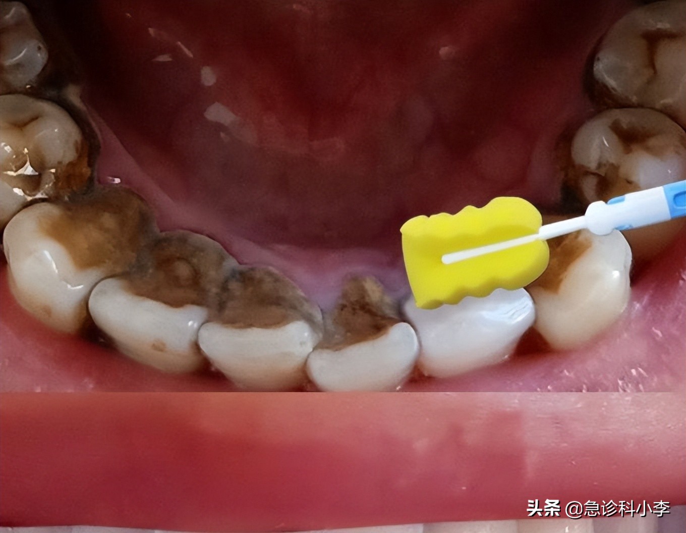 牙缝牙结石怎么自己去除,在牙缝里的牙结石要怎么去除