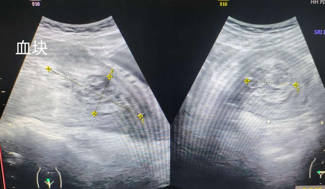 31岁妈妈顺产出院第4天大出血：“我以为生完就好了...”