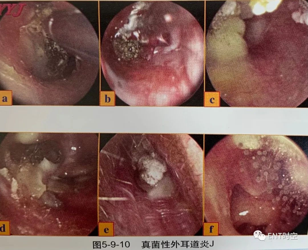 图文详解：真菌外耳道炎的诊治要点