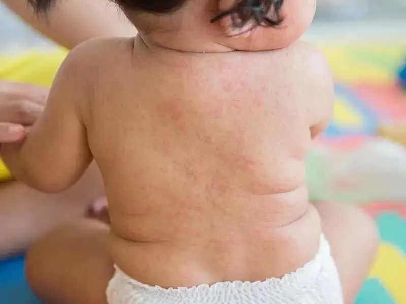 宝宝剃发后长红疹,宝宝剃光头脸上起红疹子