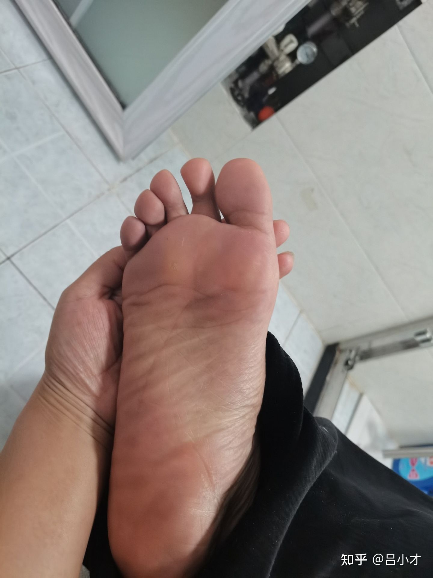 脚底长了跖疣怎么治,有没有治跖疣的好方法