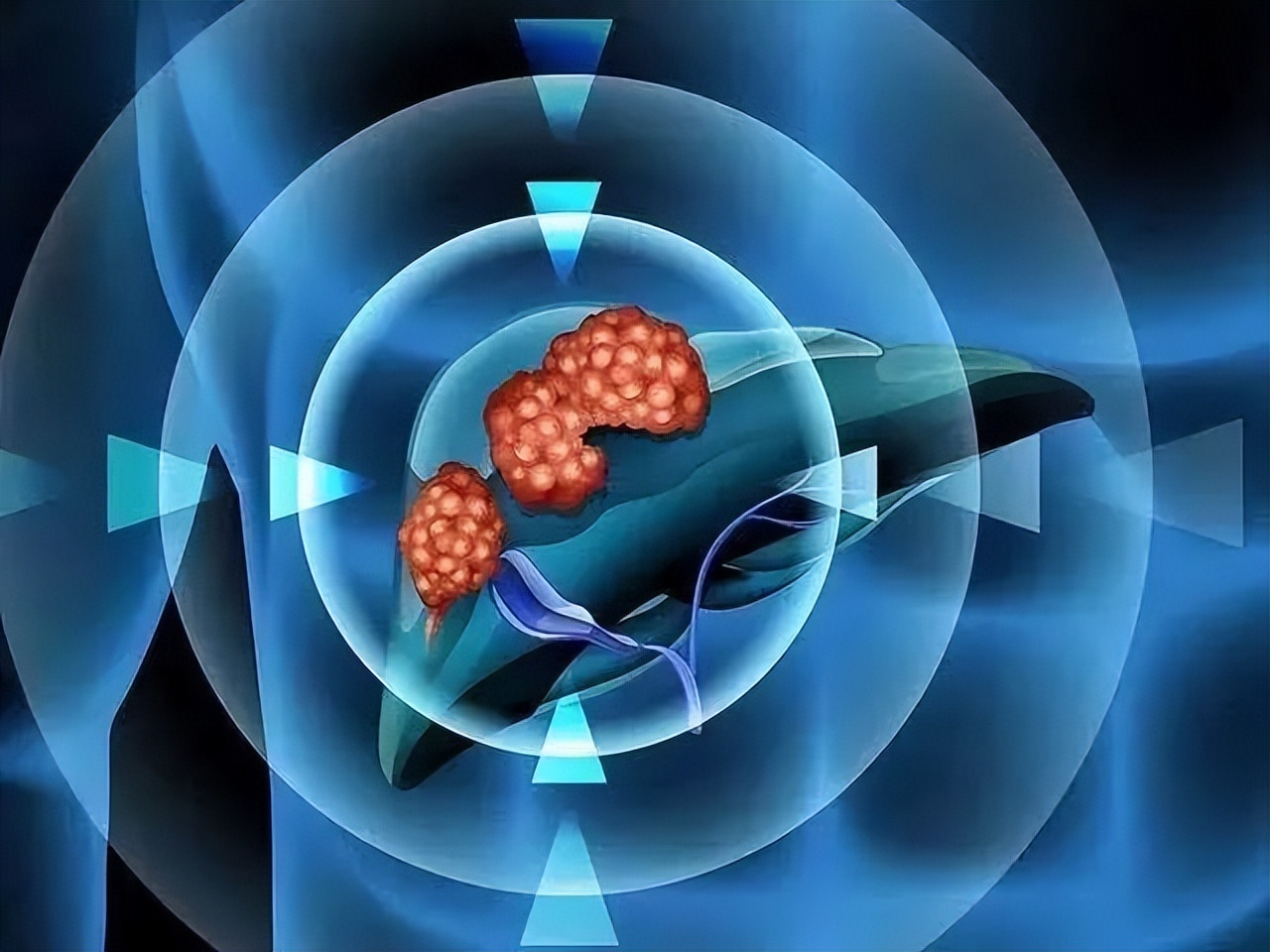 医保集采肝癌靶向药 (第四批肝癌药降价名单)