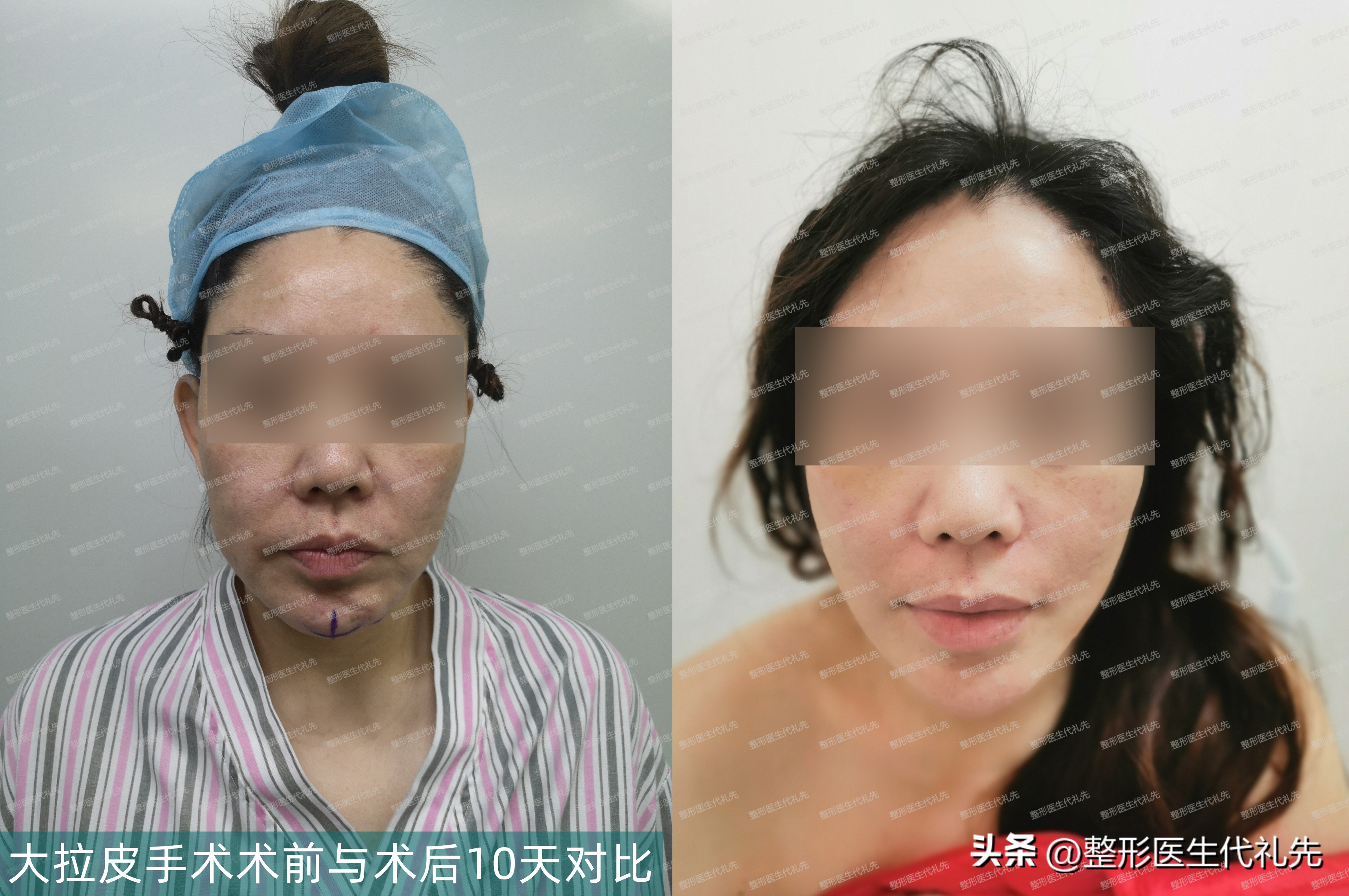 口角囊袋修复效果,口角囊袋成功修复案例